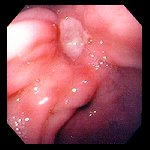 gastric ulcer image